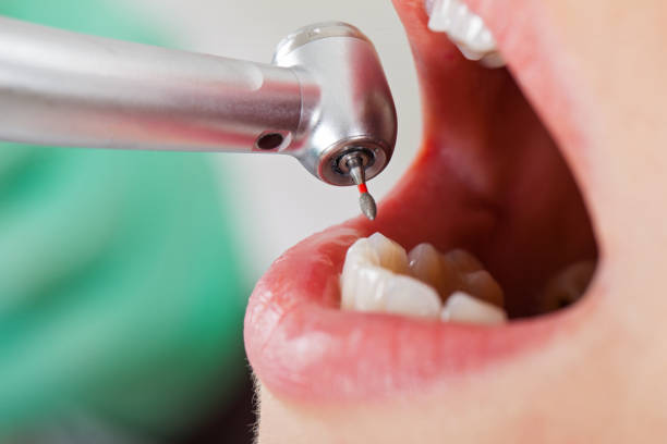 Best Emergency Dental Care for Abscessed Tooth in Millbrook, AL
